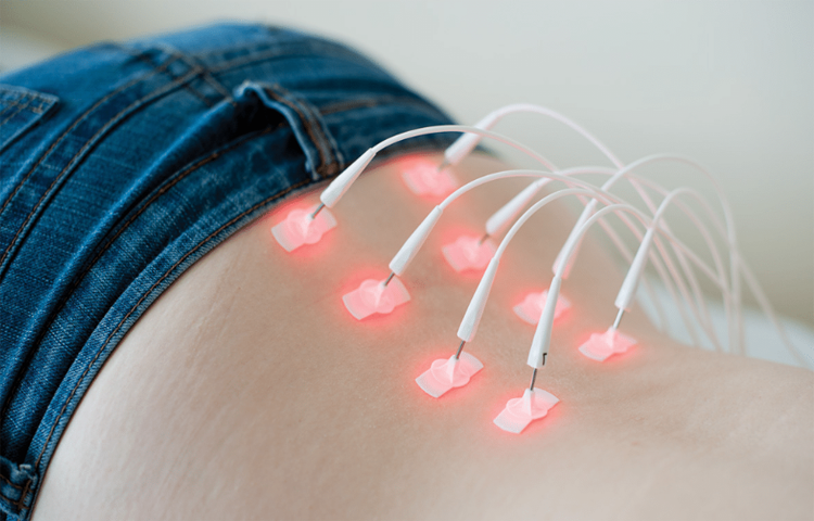 Kỹ thuật Laser châm theo y học cổ truyền